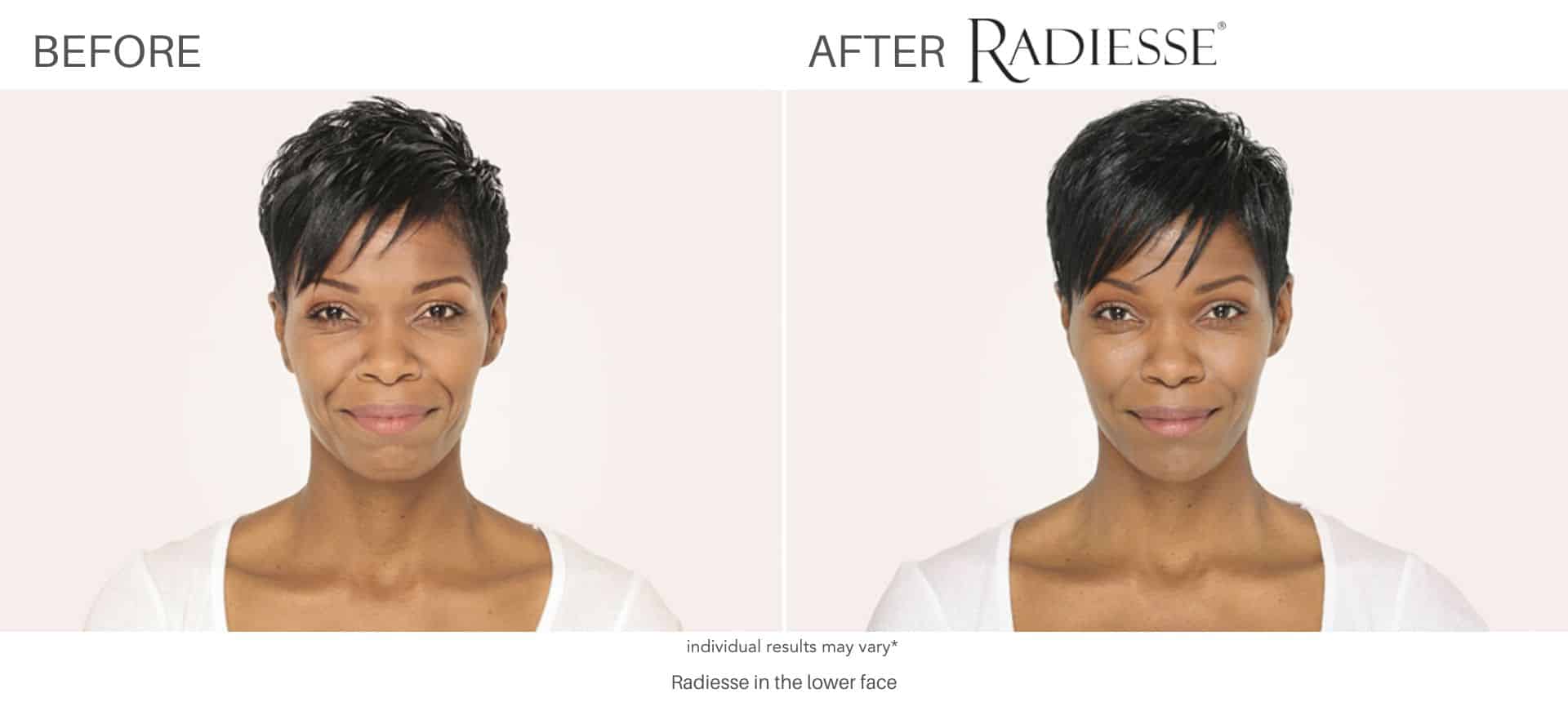 Radisse before and after results in Los Angeles, CA at Sculpt DTLA.