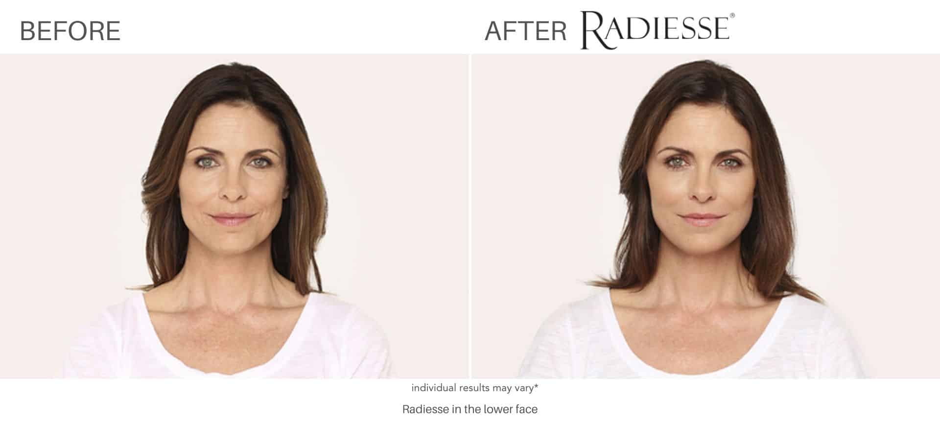 Radisse before and after results in Los Angeles, CA at Sculpt DTLA.