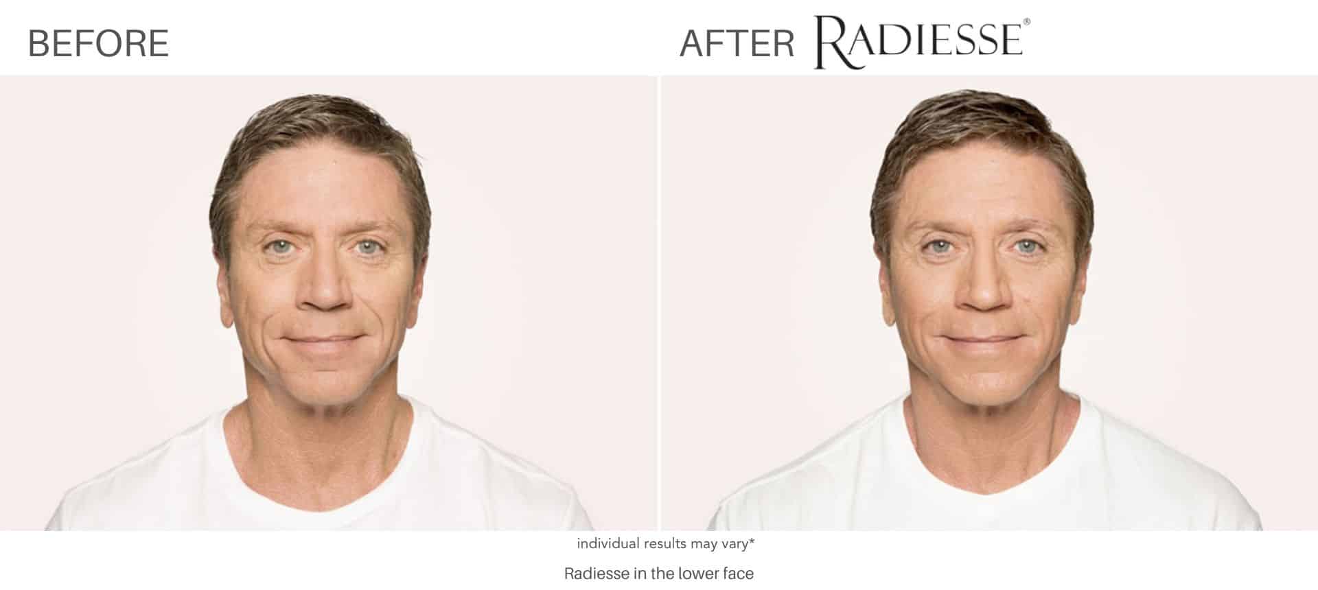 Radisse before and after results in Los Angeles, CA at Sculpt DTLA.