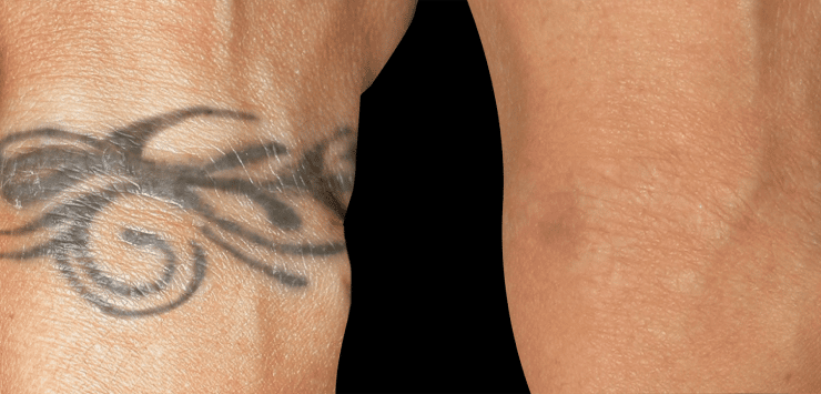 How Long Does Laser Tattoo Removal Take to Heal?