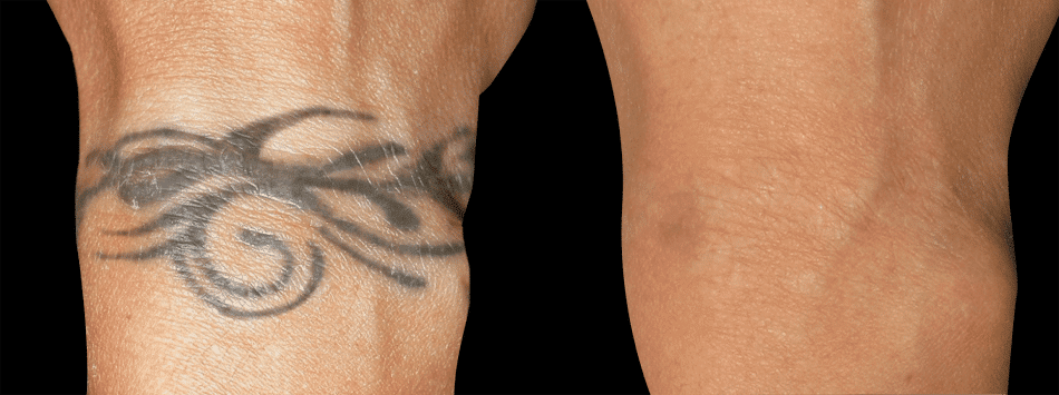 How Long Does Laser Tattoo Removal Take to Heal?