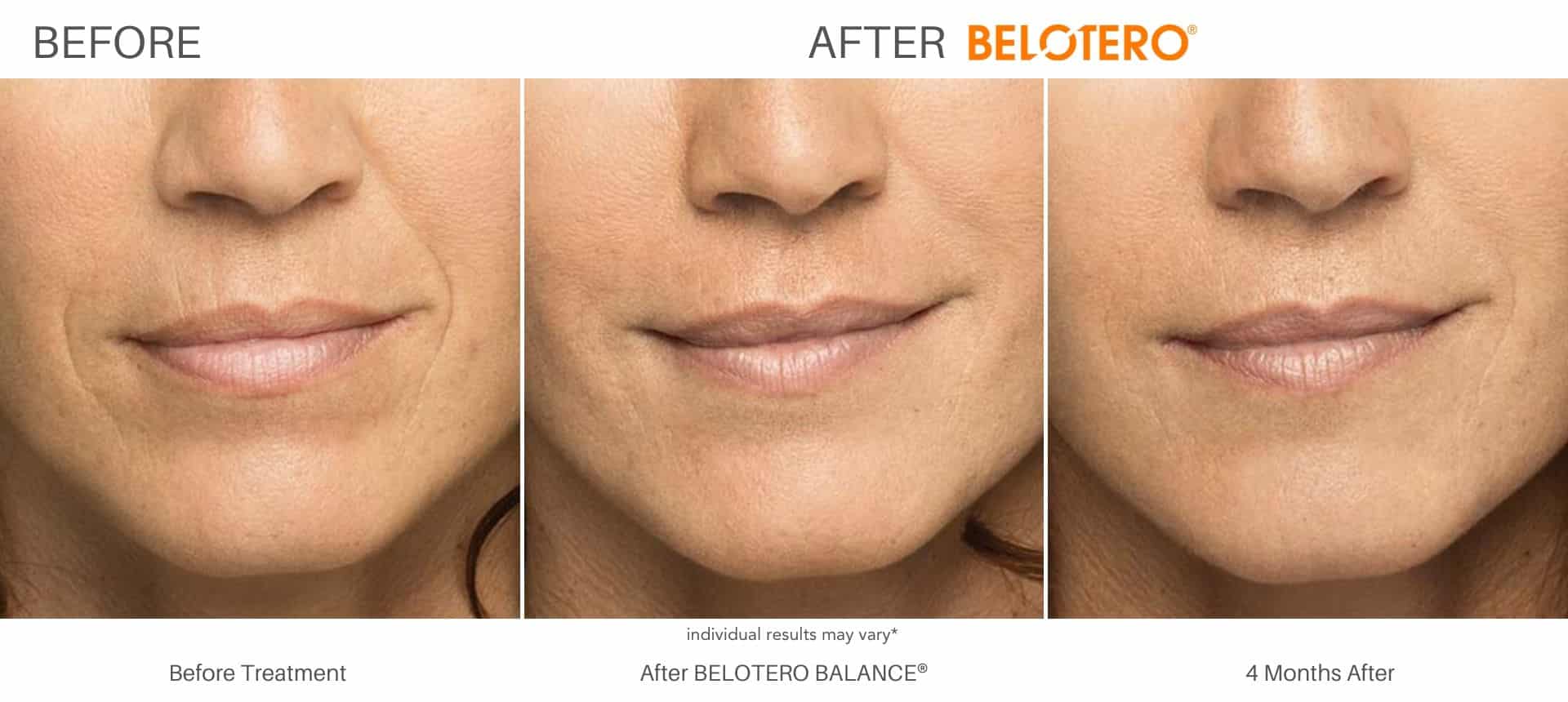 Belotero before and after results in Los Angeles, CA at Sculpt DTLA.