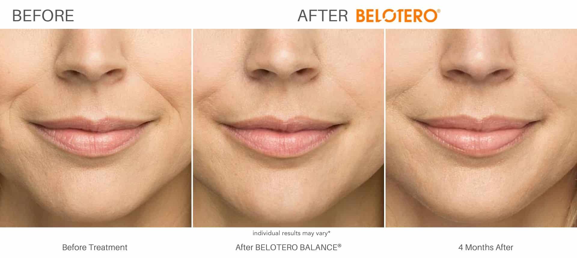 Belotero before and after results in Los Angeles, CA at Sculpt DTLA.