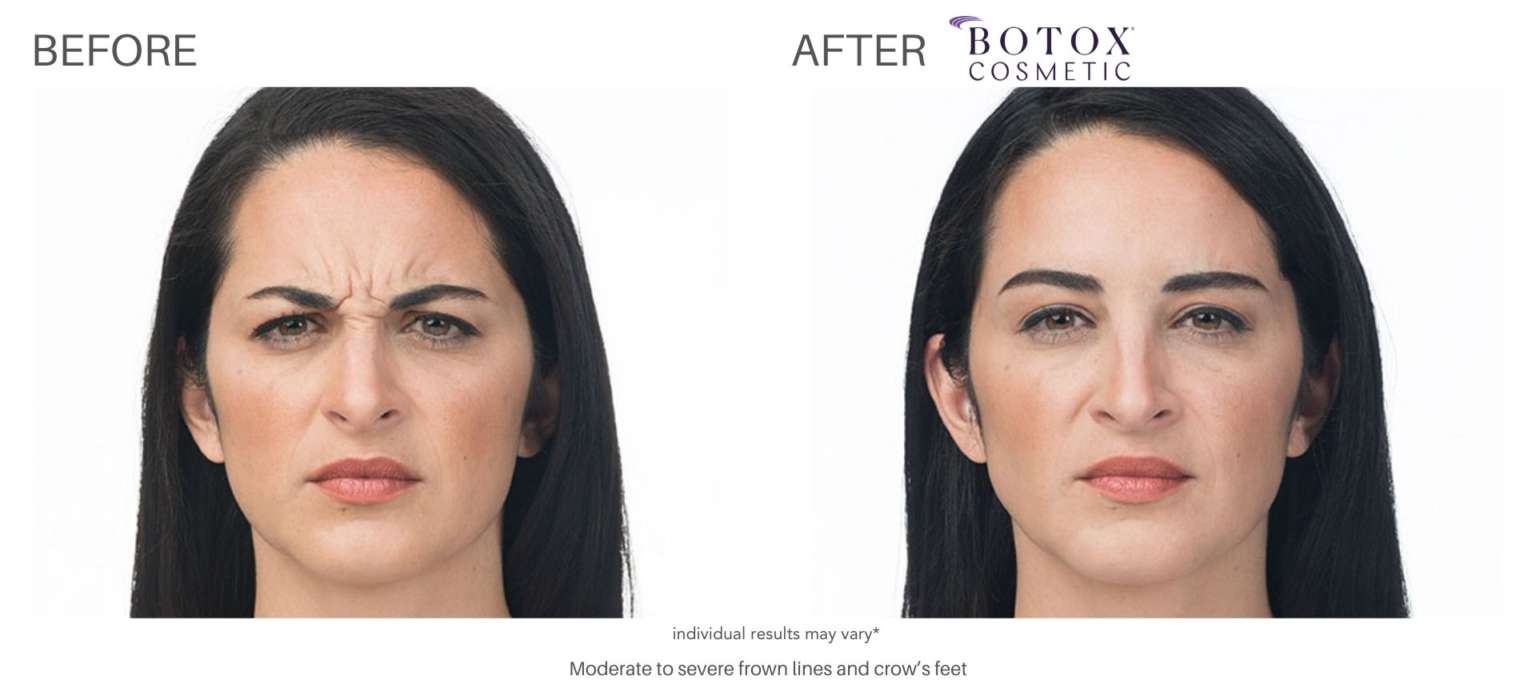Botox Before And After: Real Results From Real Patients - Sculptdtla.Com