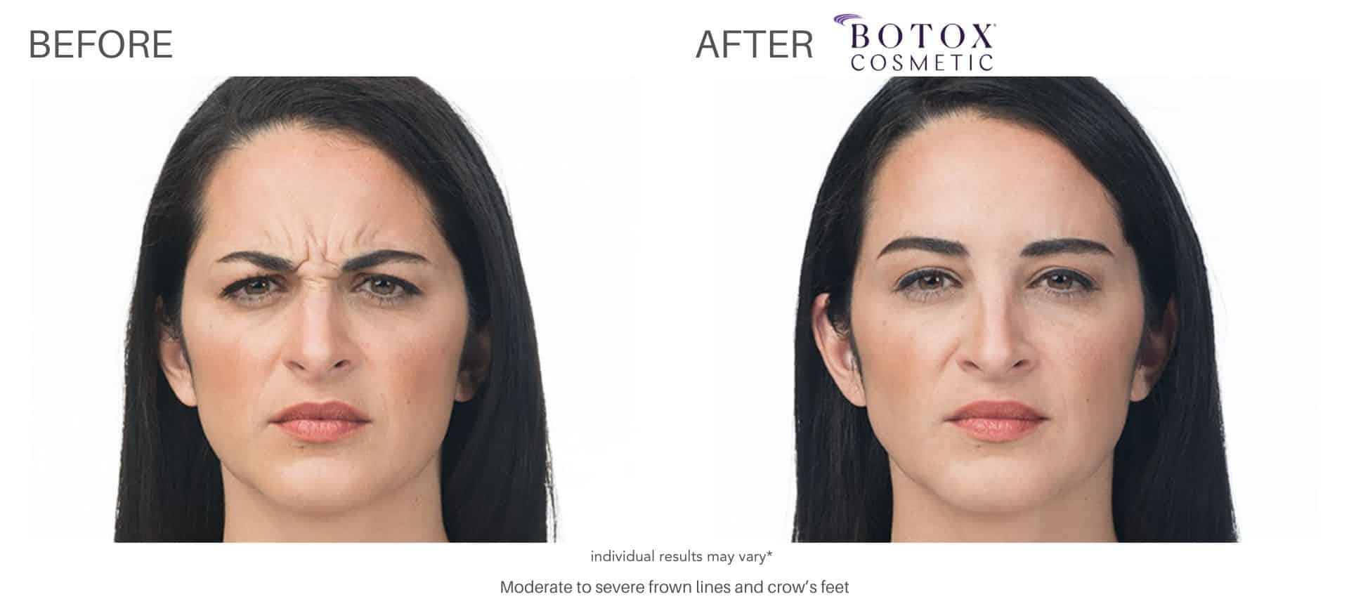 botox before and after results in Los Angeles at Sculpt DTLA.