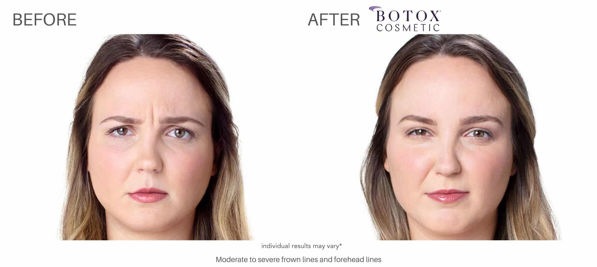 botox before and after results in Los Angeles at Sculpt DTLA.