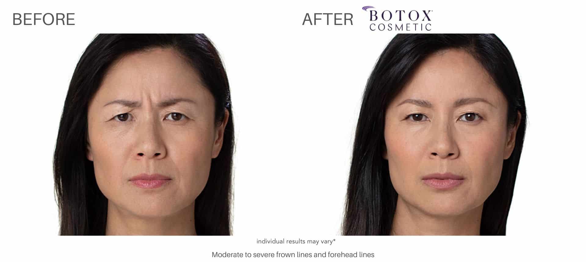 botox before and after results in Los Angeles at Sculpt DTLA.