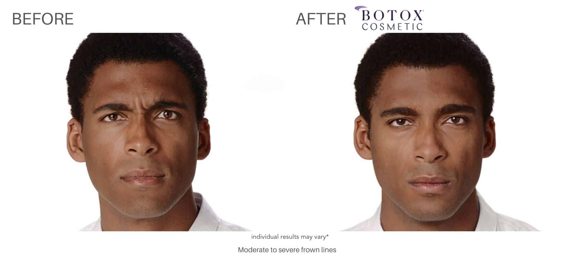 botox before and after results in Los Angeles at Sculpt DTLA.