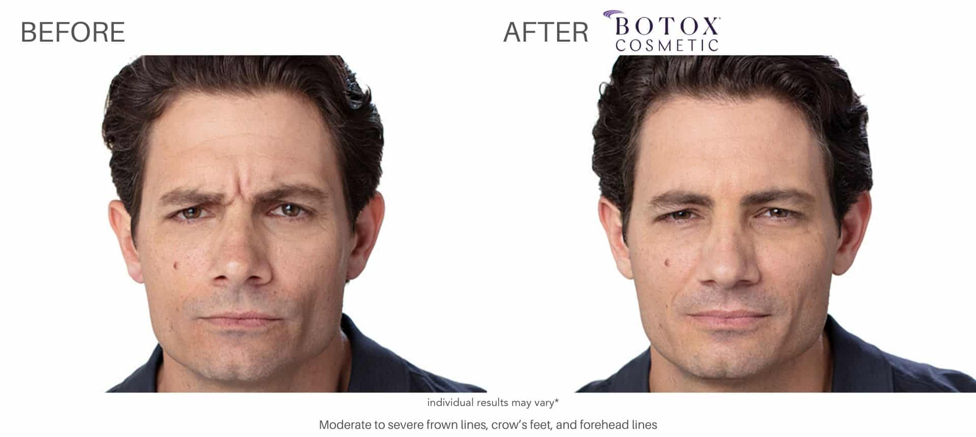 botox before and after results in Los Angeles at Sculpt DTLA.