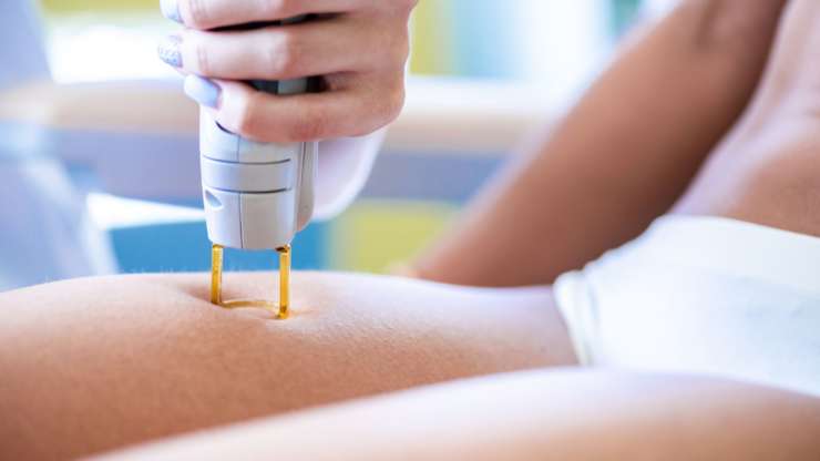 Is Laser Hair Removal Painful on Different Body Parts?