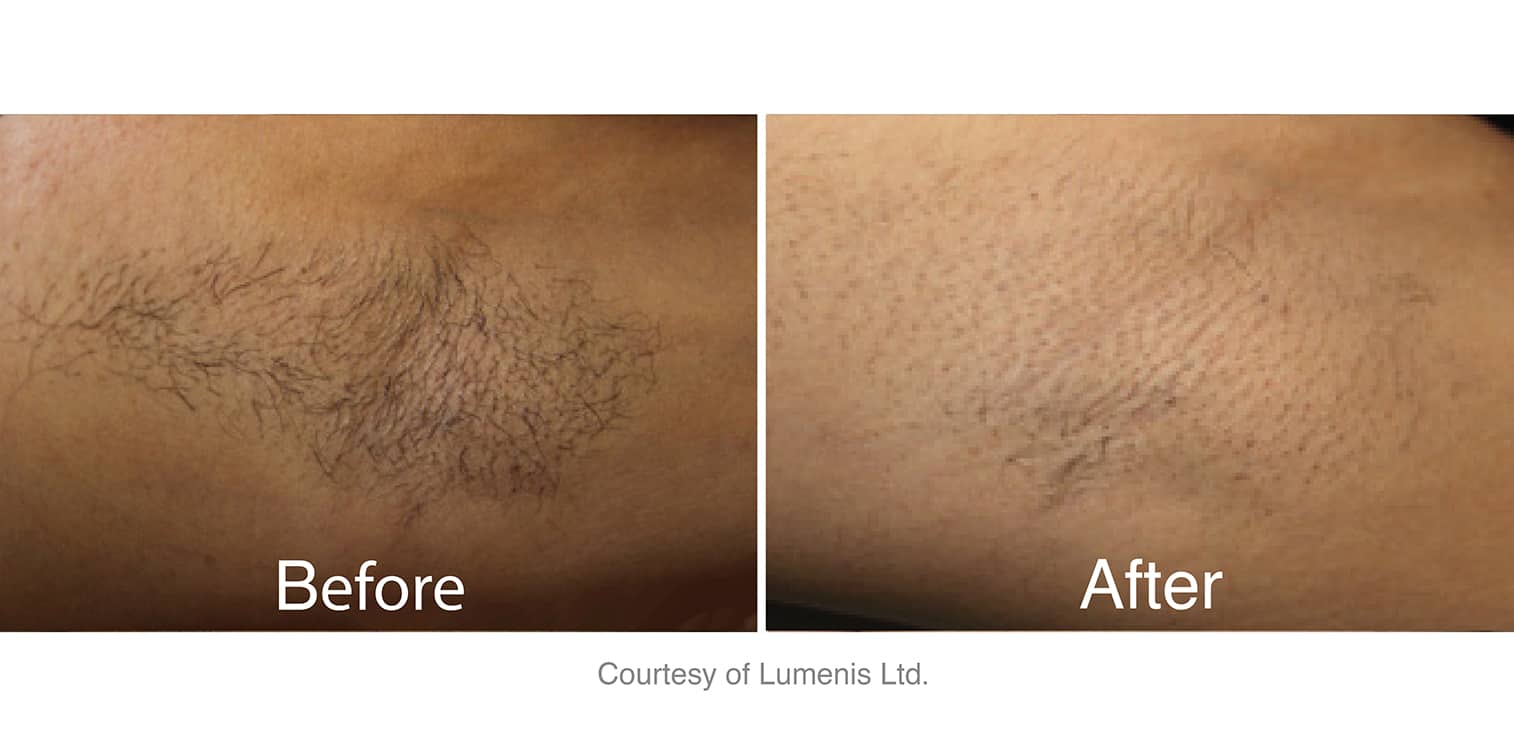 laser hair removal before and after under arm in Los Angeles at Sculpt DTLA.