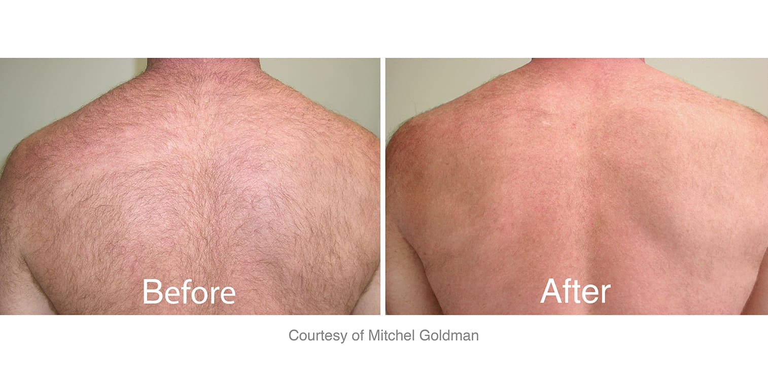 laser hair removal on back before and after results in Los Angeles at Sculpt DTLA.
