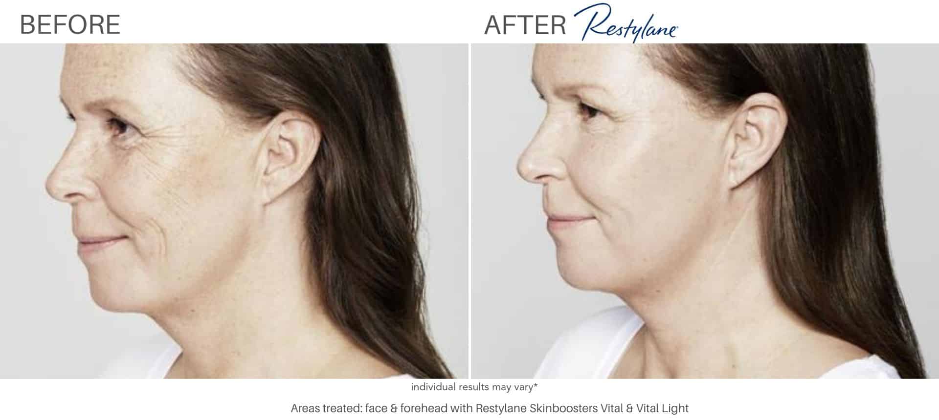 Restylane before and after results in Los Angeles, CA at Sculpt DTLA.