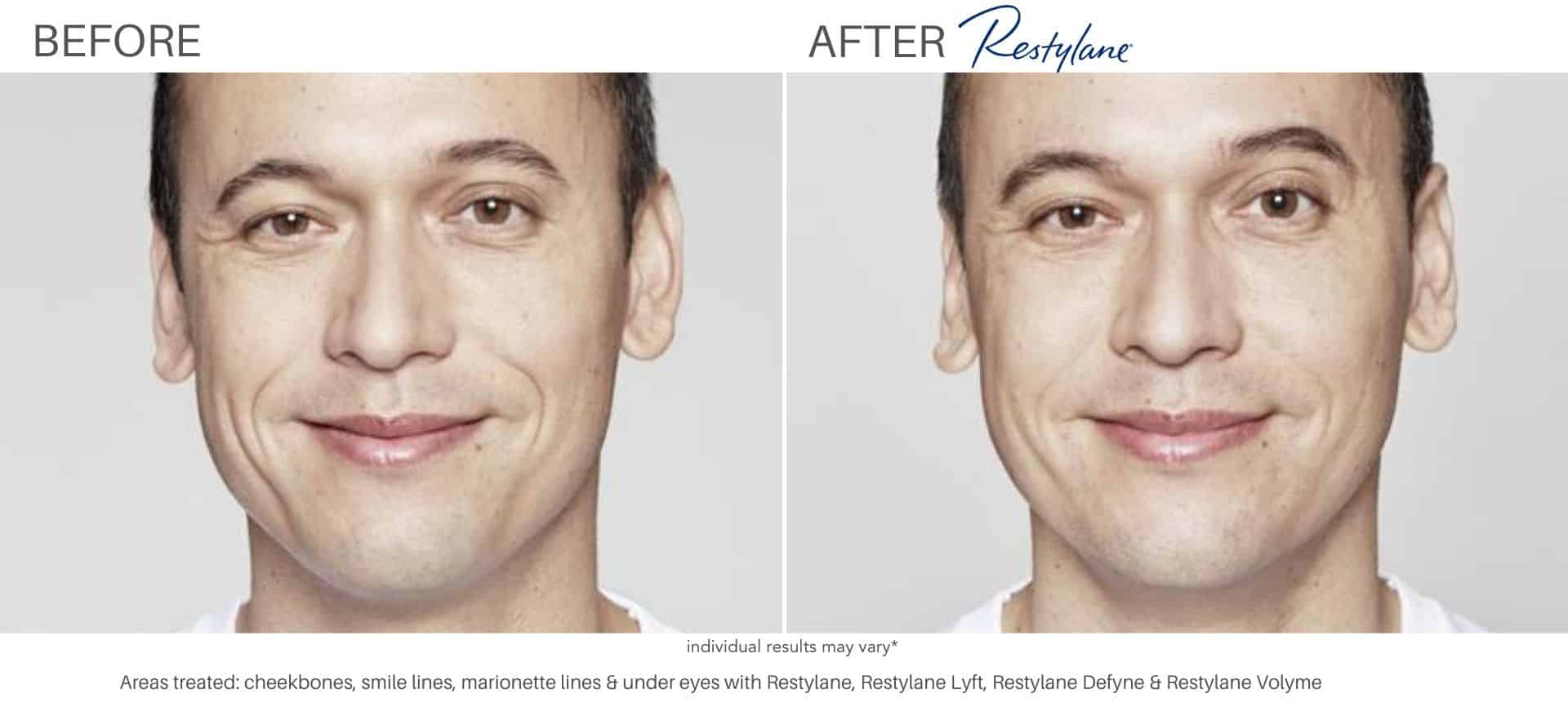 Restylane before and after results in Los Angeles, CA at Sculpt DTLA.