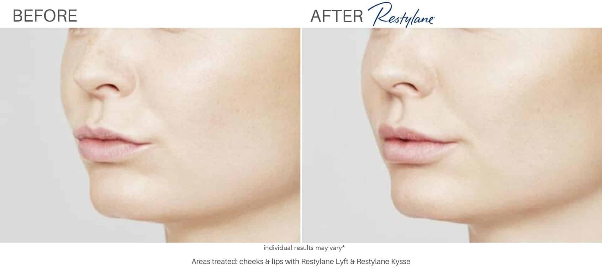 Restylane before and after results in Los Angeles, CA at Sculpt DTLA.