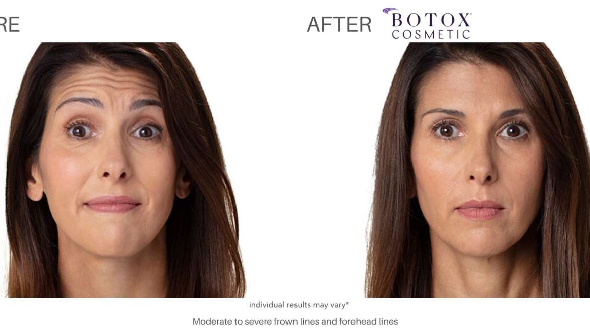 Botox Before and After:  Real Results from Real Patients