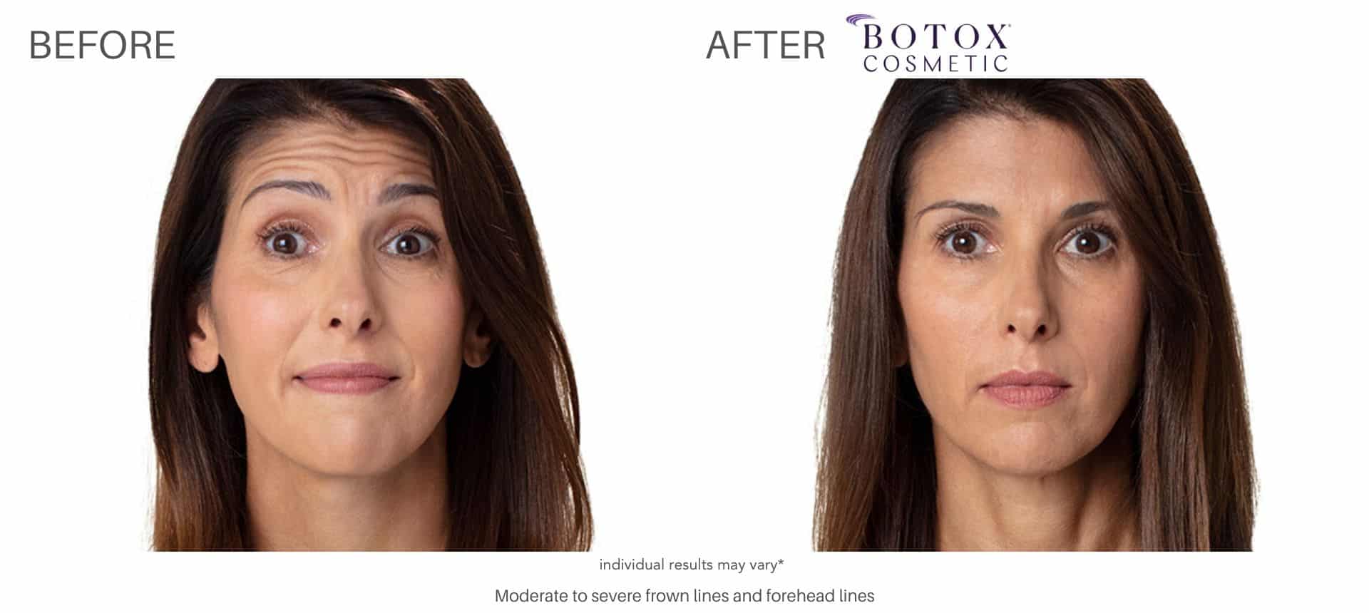 Botox before and after pictures
