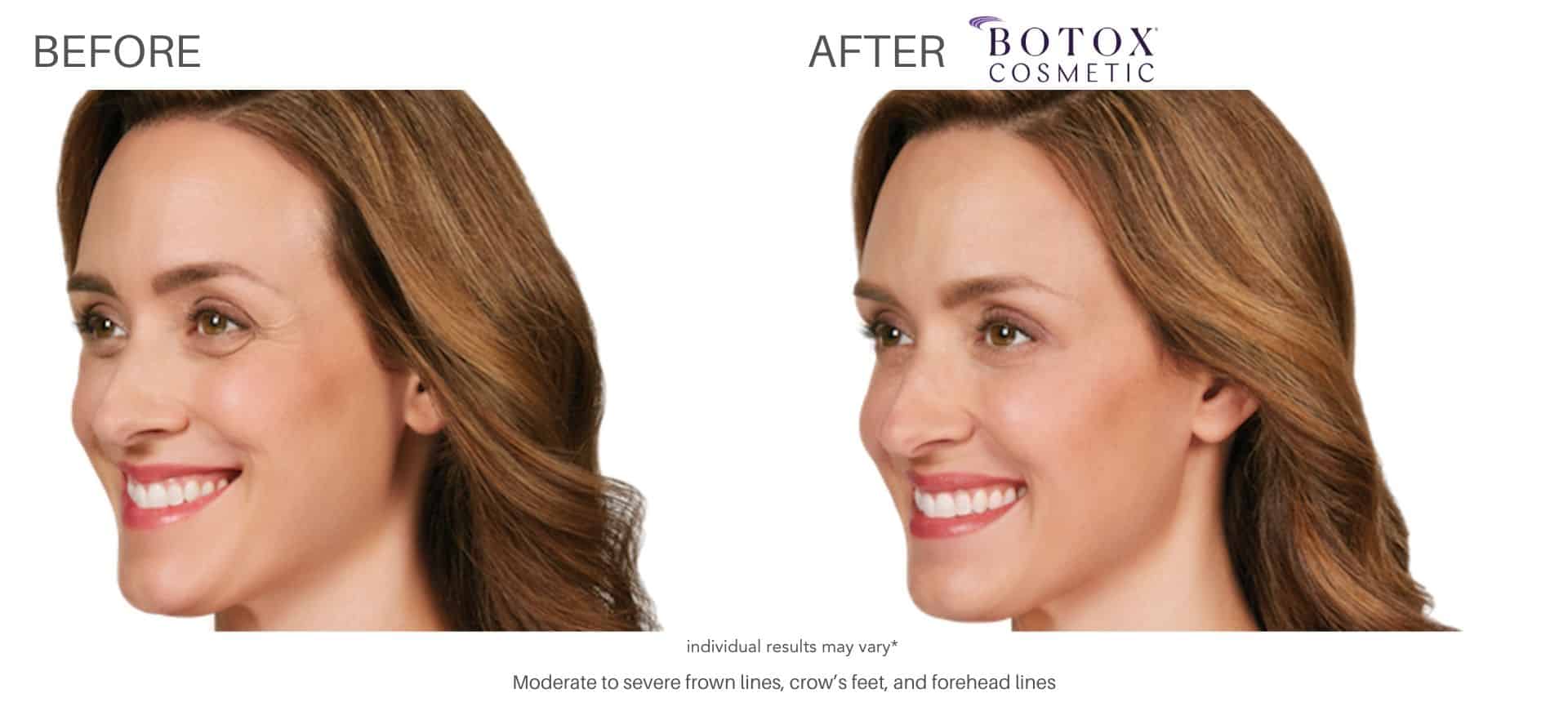 Botox Before and After real patient results silverlake