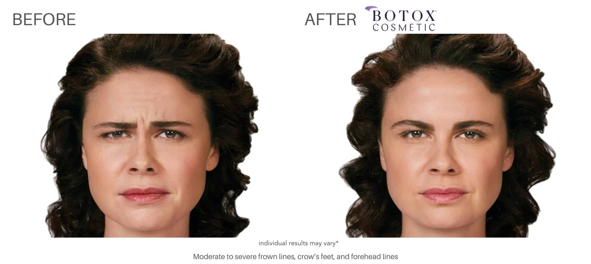 Botox amazing results in Silverlake
