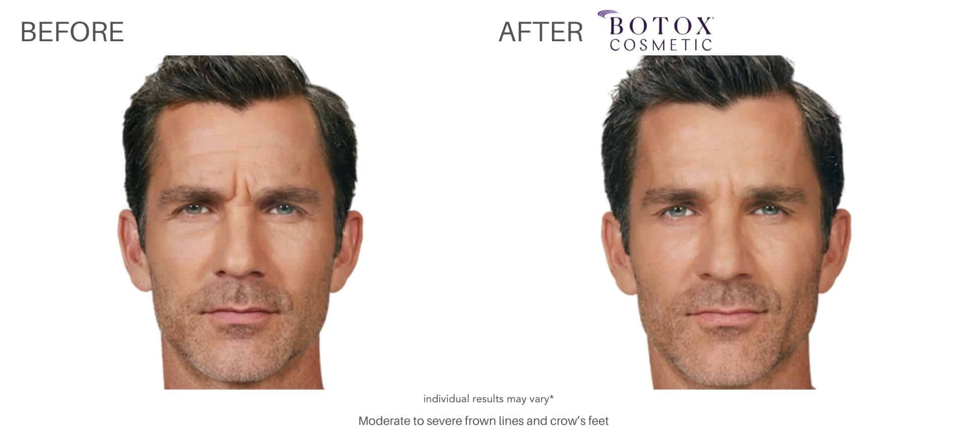 Botox injection treatments in Silverlake
