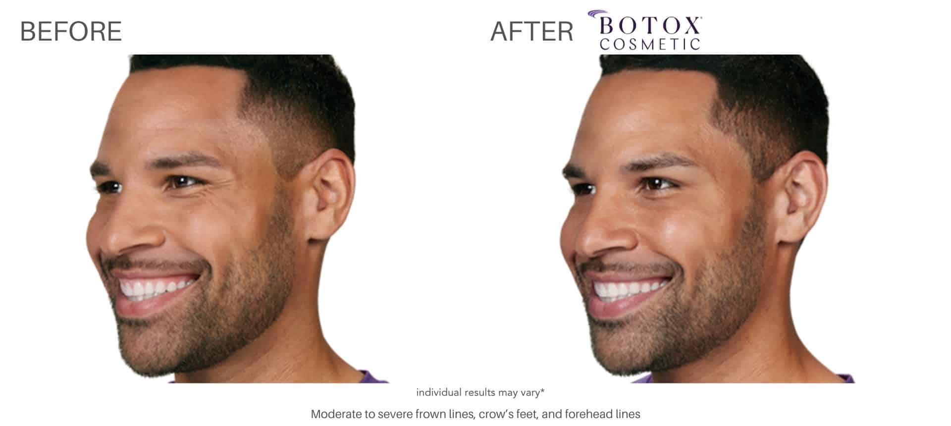 Botox injection treatments for men in Silverlake