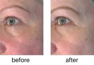vivace_microneedling_before_and_after_1