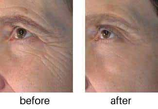 vivace_microneedling_before_and_after_2