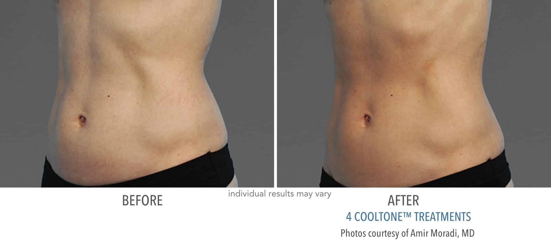 Abdomen before and after cooltone treatment at Sculpt DTLA in Los Angelas.