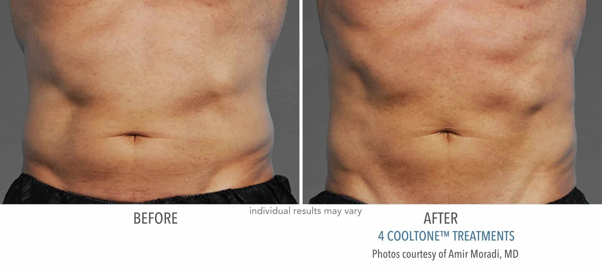 Abdomen before and after cooltone treatment at Sculpt DTLA in Los Angelas.