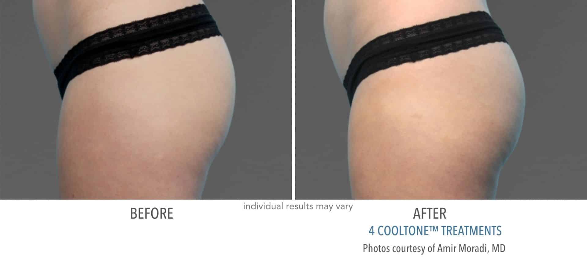 Buttocks before and after cooltone treatment at Sculpt DTLA in Los Angelas.
