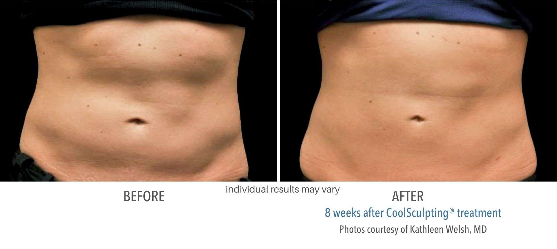 CoolSculpting before and after results from real patients