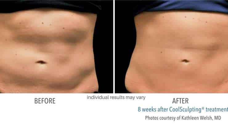 CoolSculpting before and after results from real patients