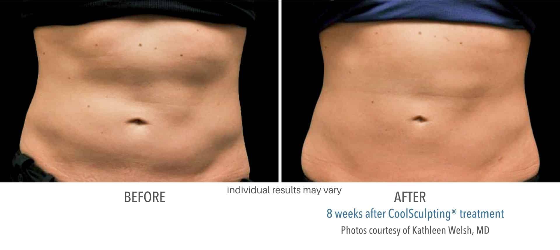 coolsculpting treatment stomach fat in Los Angeles
