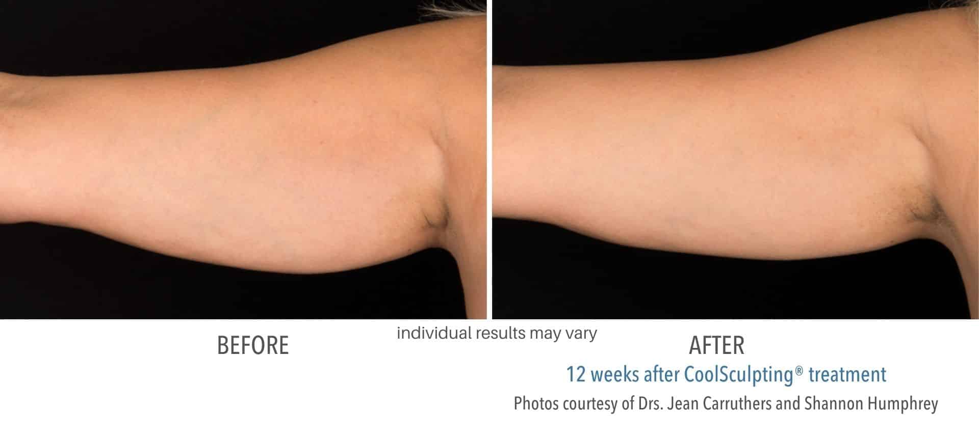 coolsculpting arm fat treatment in Los Angeles