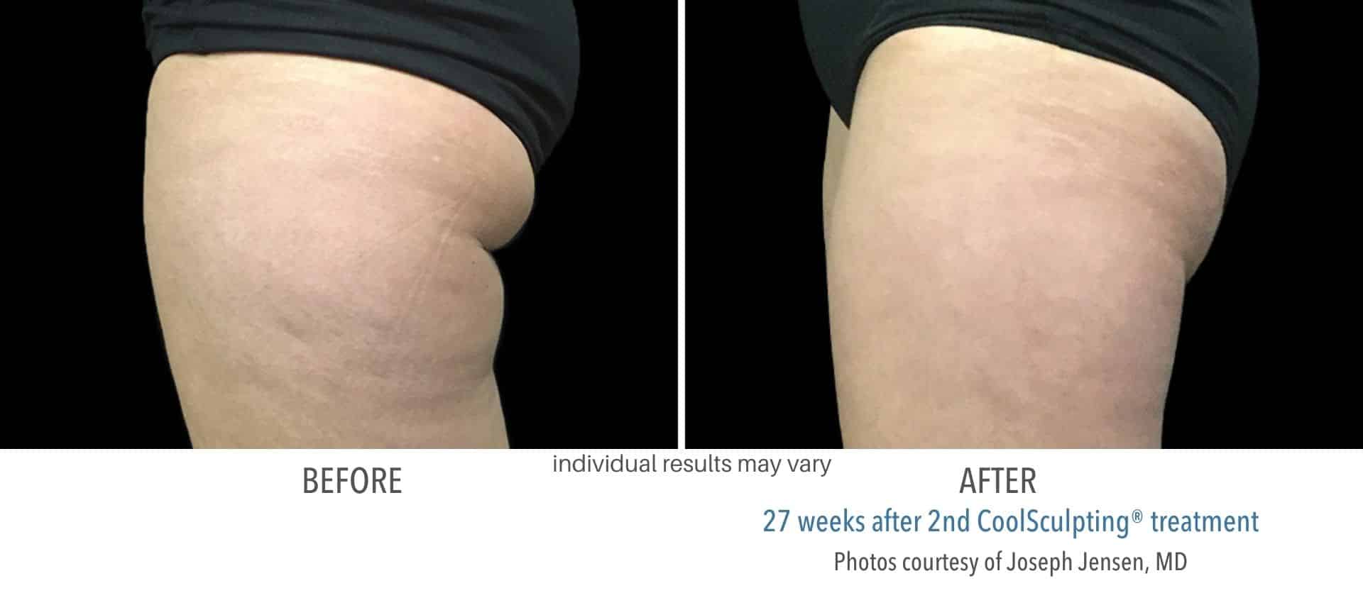 coolsculpting outer thigh treatment in Los Angeles