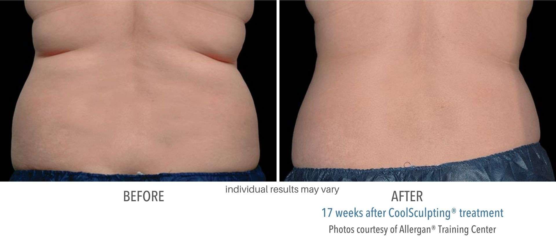 CoolSculpting before and after results from real patients