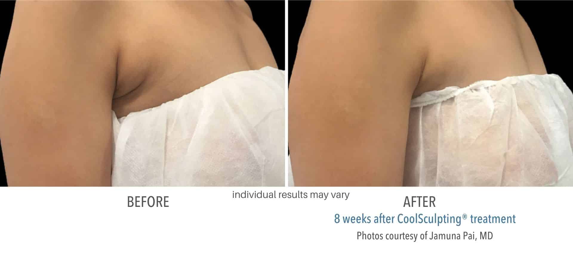 coolsculpting treatment armpit fat in Los Angeles