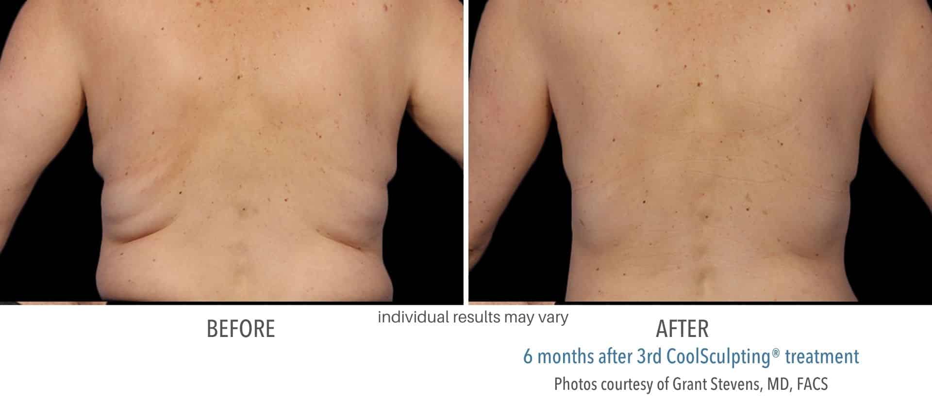 coolsculpting treatment back fat for male in Los Angeles