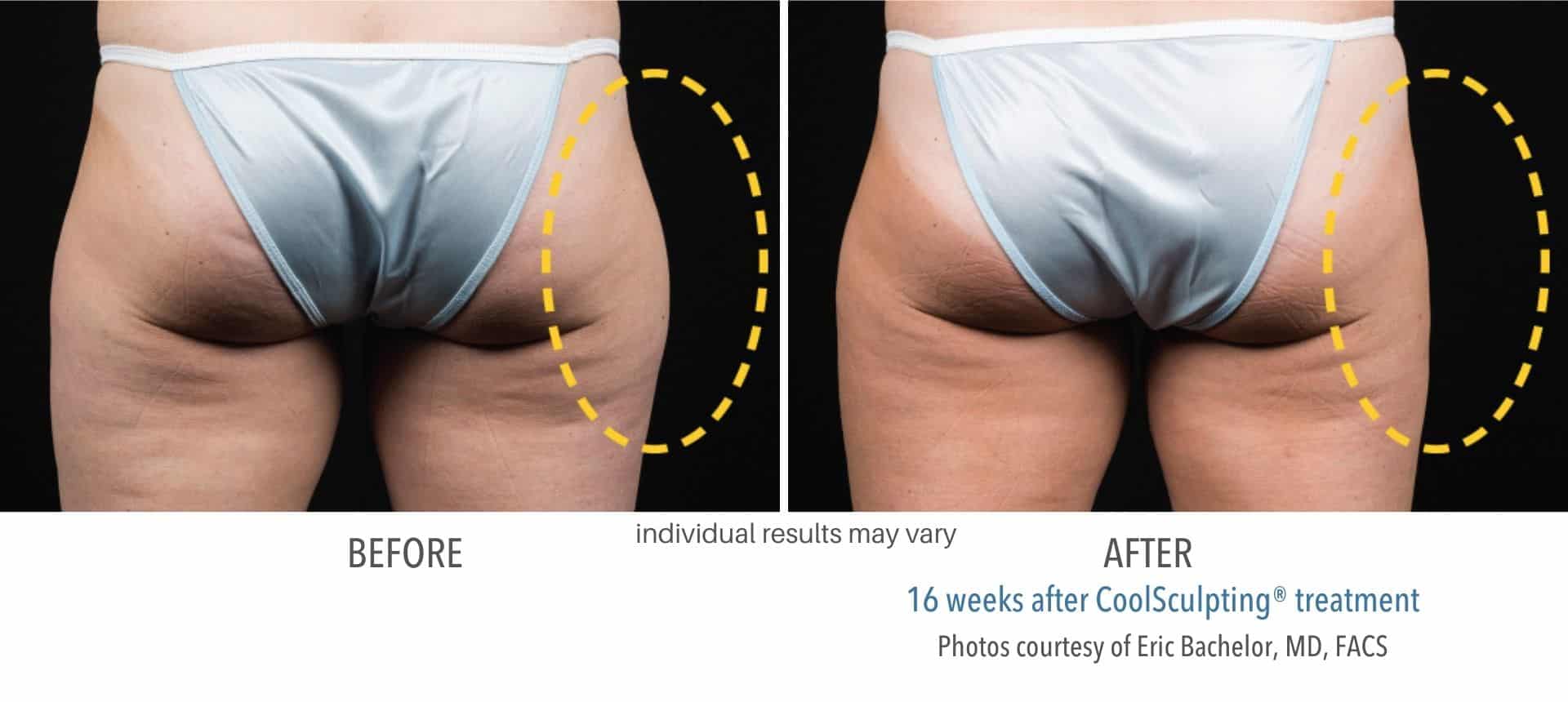 coolsculpting outer thigh treatment at Sculpt DTLA