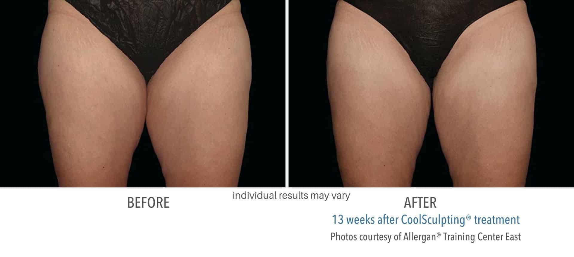 coolsculpting thigh treatment in Los Angeles