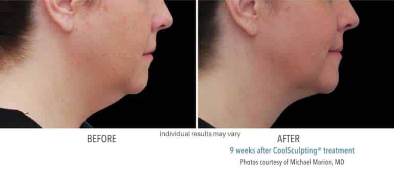 CoolSculpting before and after results from real patients Sculpt Med Spa CoolSculpting before and after results from real patients Sculpt Med Spa