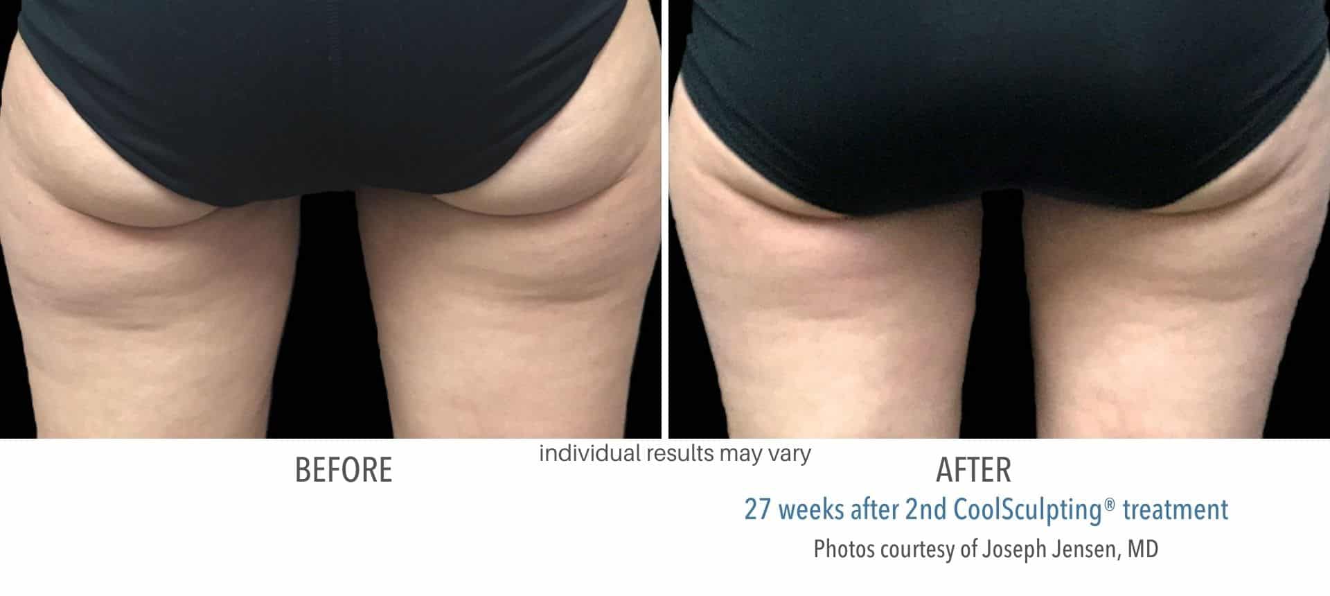 coolsculpting female thigh treatment in Los Angeles