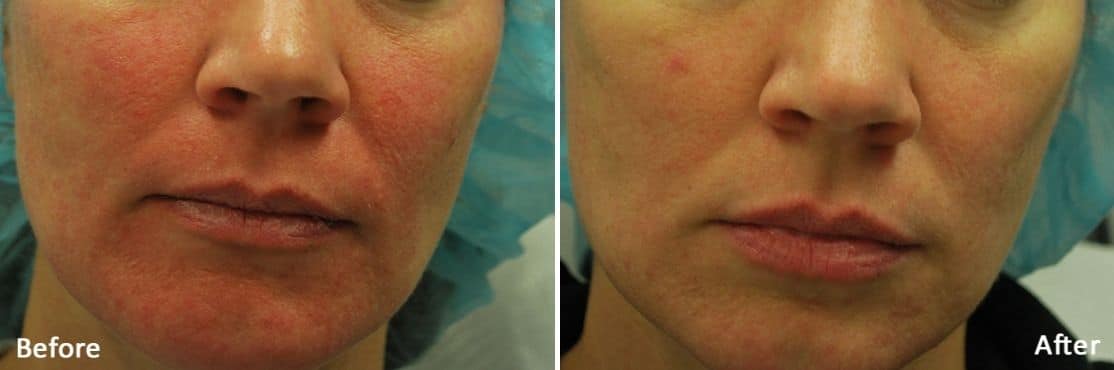 Morpheus8 Skin Rejuvenation in Downtown LA | Before And After Image 1