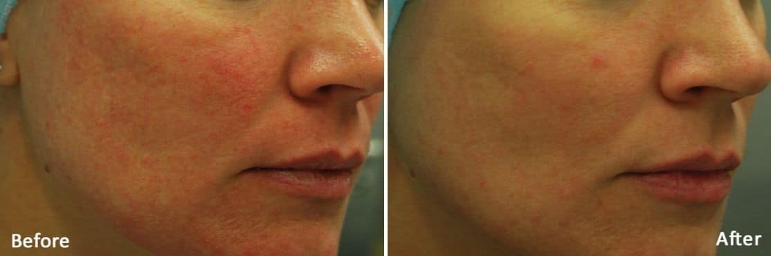 Morpheus8 Skin Rejuvenation in Downtown LA | Before And After Image 3