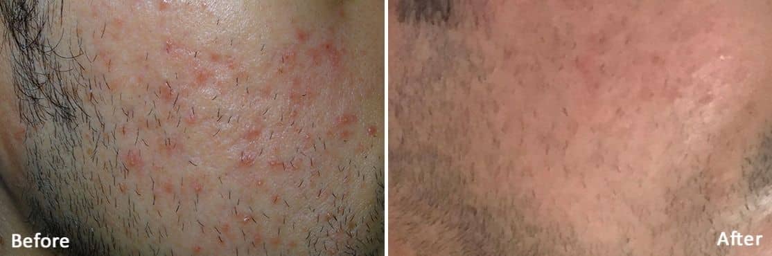 Morpheus8 Skin Rejuvenation in Downtown LA | Before And After Image 4