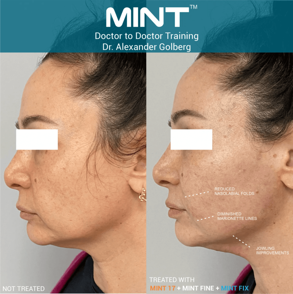 MINT PDO before and after (1)