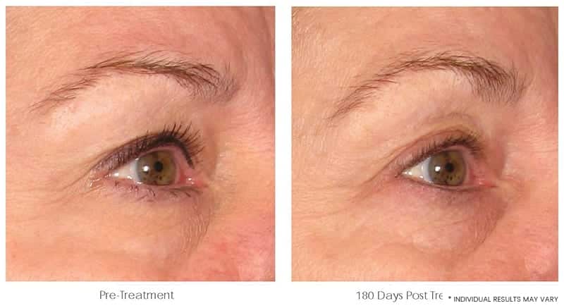 Ultherapy Downtown LA - Non Invasive Skin Tightening | Before & After Image 3