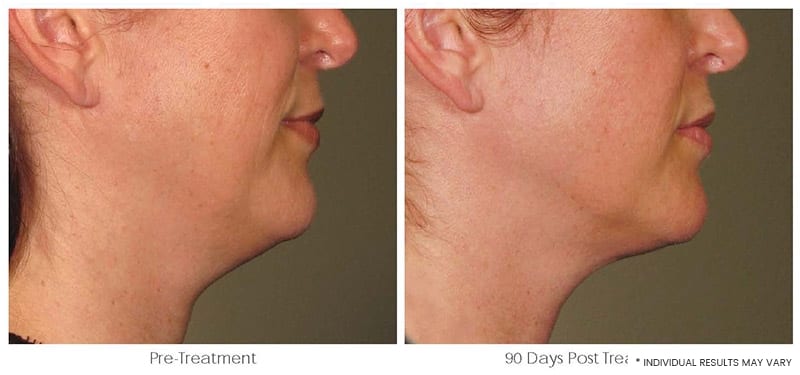 Ultherapy Downtown LA - Non Invasive Skin Tightening | Before & After Image 1