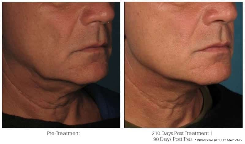 Ultherapy Downtown LA - Non Invasive Skin Tightening | Before & After Image 4