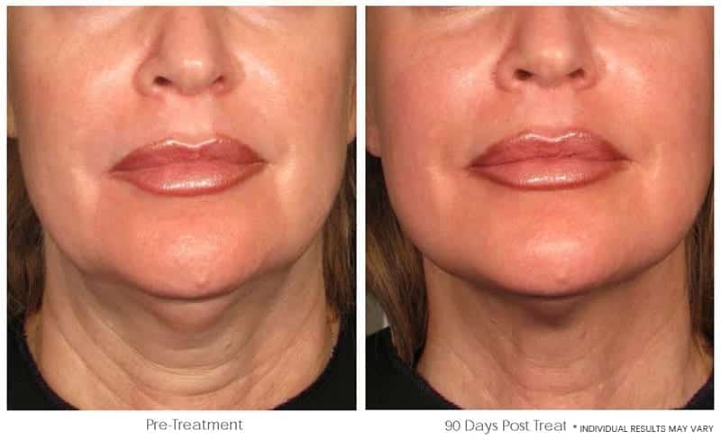 Ultherapy Downtown LA - Non Invasive Skin Tightening | Before & After Image 2